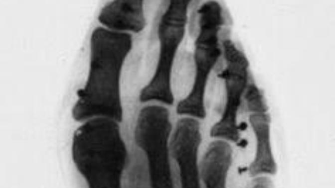 Would you wear high healed shoes even if they are unhealthy? Why?