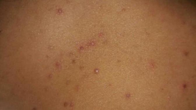 Afraid that my boyfriend would judge me for my acne?