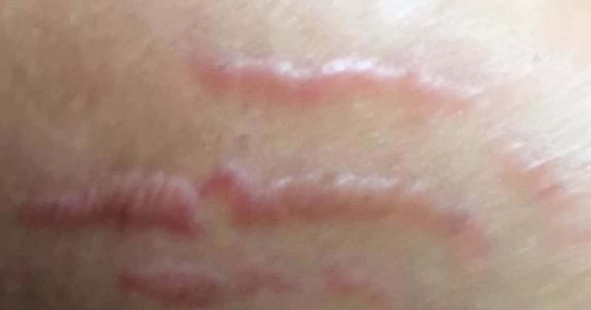 Why does my stretch mark look like this? How to get rid of it right