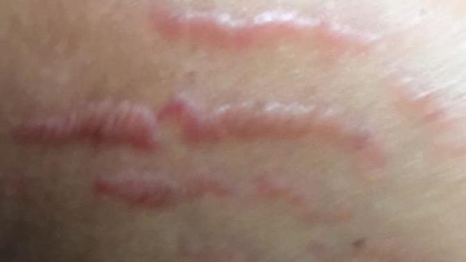 Why does my stretch mark look like this? How to get rid of it right away?