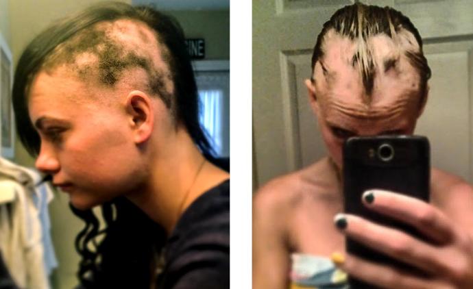 Would you date someone who suffers from alopecia (hair loss)?