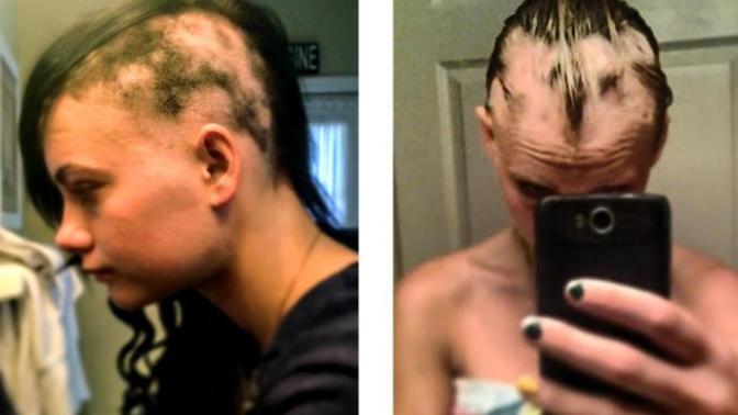 Would you date someone who suffers from alopecia (hair loss)?
