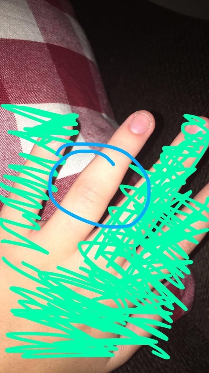 Jammed finger bad?