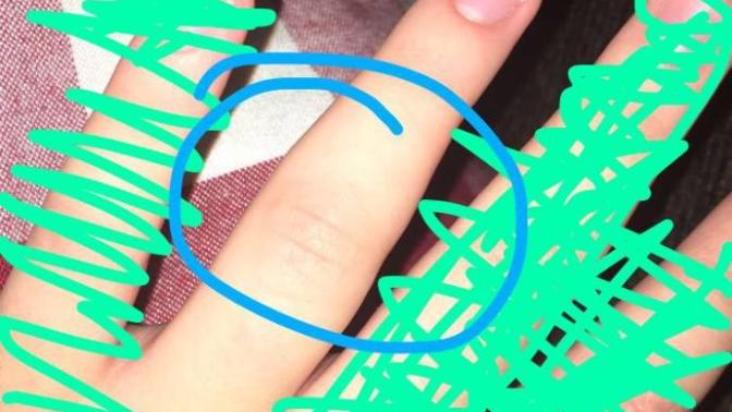 Jammed finger bad?