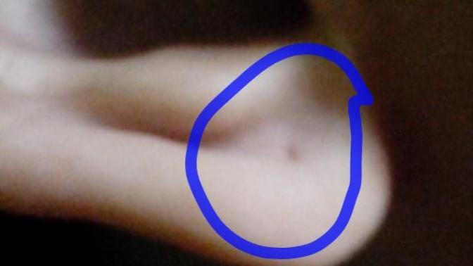 Is my old ear piercing infected?