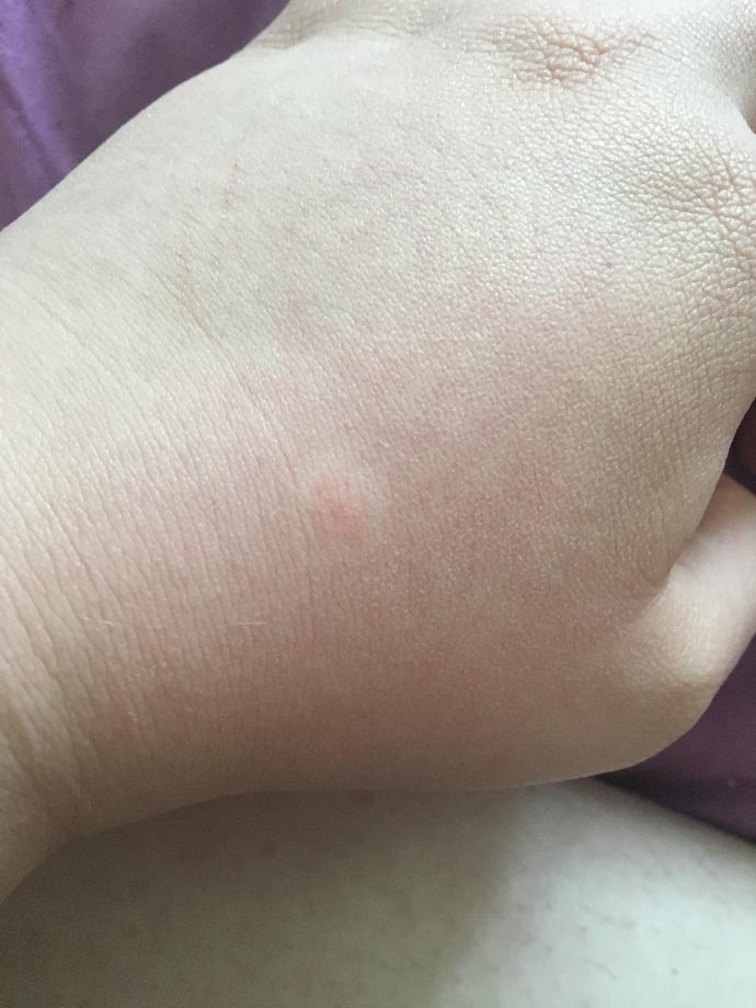 What is this on my hand?