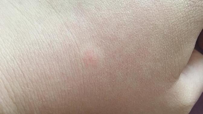 What is this on my hand?