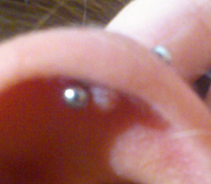 I got my ear pierced a couple of months ago and I have something like a pimple now. It's pretty big. Picture below. What should I do?