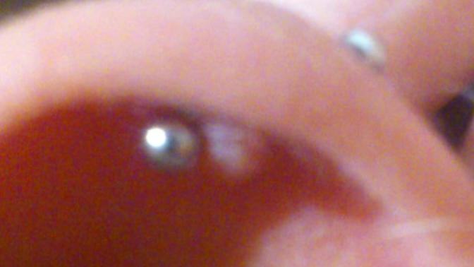 I got my ear pierced a couple of months ago and I have something like a pimple now. It's pretty big. Picture below. What should I do?