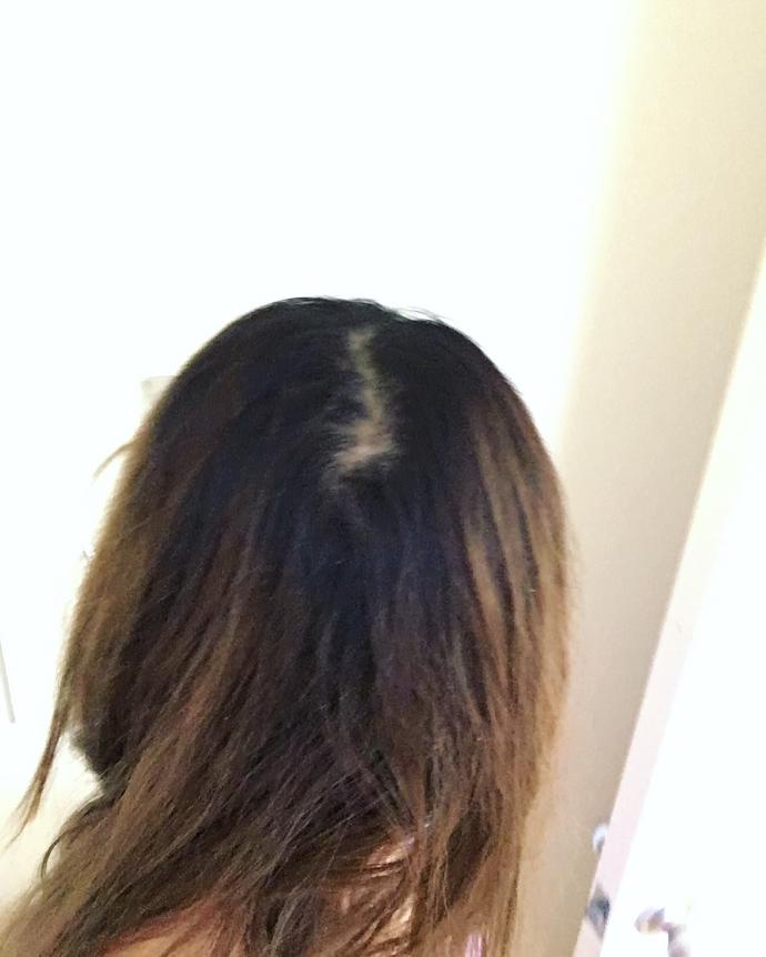 See picture: is my friend going bald at such a young age? <br />?