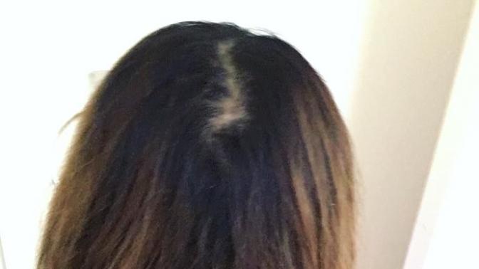 See picture: is my friend going bald at such a young age? 
?