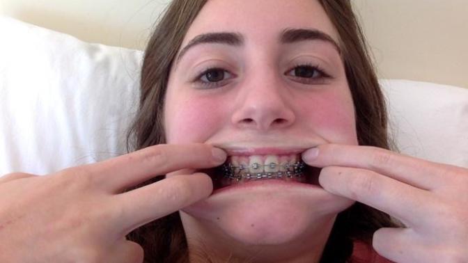 What else do they have to fix till I get my braces off?