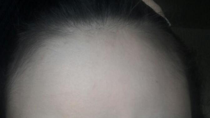 Is my hair thinning, am I going bald (pics)?