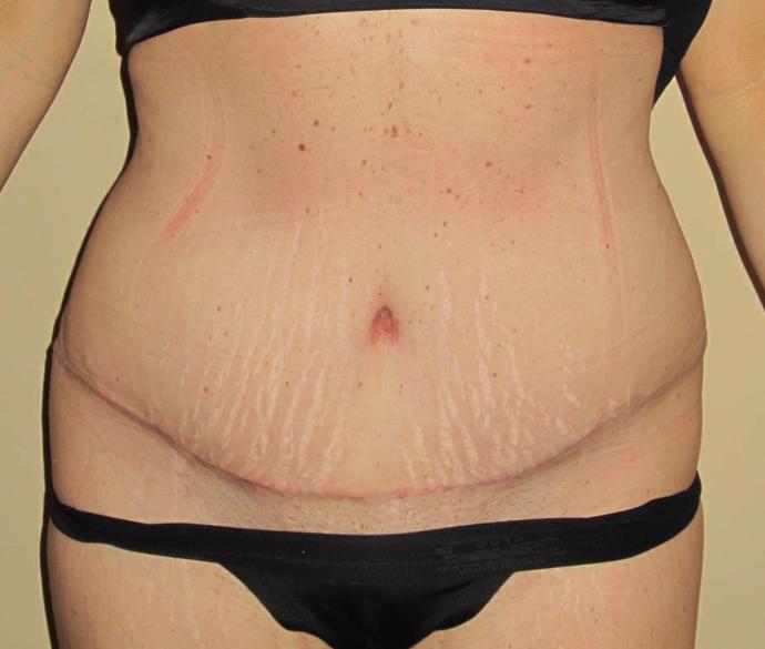Guys, would you consider being with long term a woman who had a tummy tuck due to weight loss if you thought she was beautiful besides that?