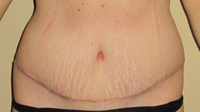 Guys, would you consider being with long term a woman who had a tummy tuck due to weight loss if you thought she was beautiful besides that?