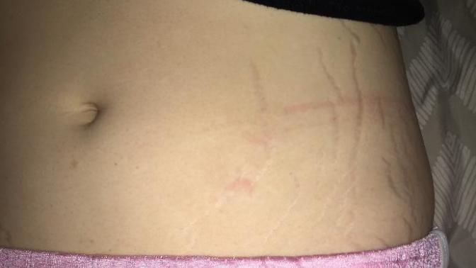 Are stretch marks a major turn off?