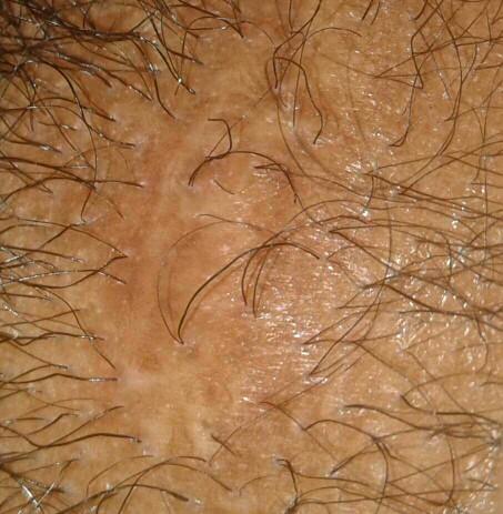 scalp scar is growing hair!! how????