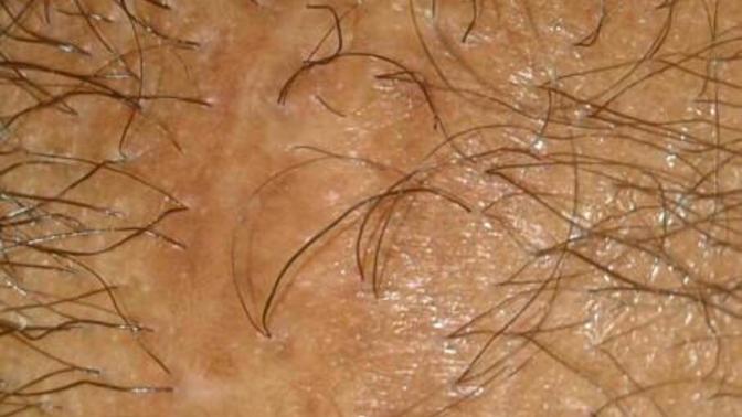 Scalp scar is growing hair!! how?