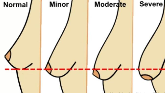Would you rather have saggy boobs or perky ones but with scars from a breast lift?