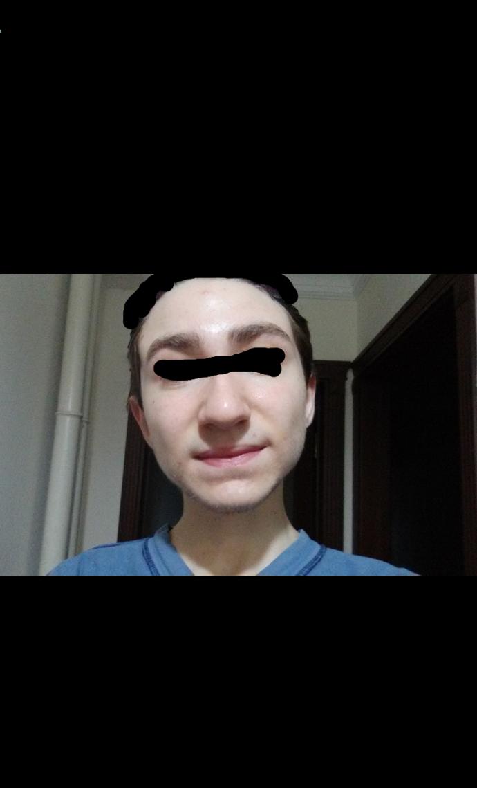 Do my acnes look too bad?