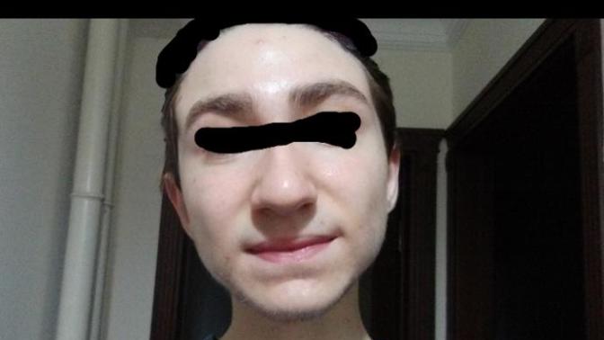 Do my acnes look too bad?