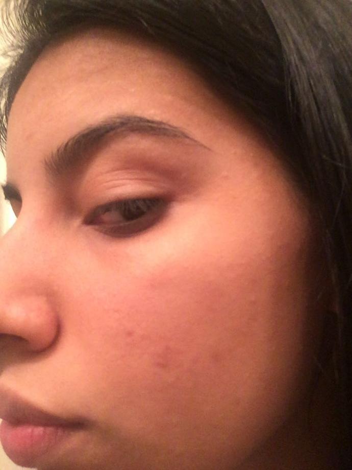 Girls, What could you recommend me that has worked for you to get rid of past acne marks ( dark spots) help?
