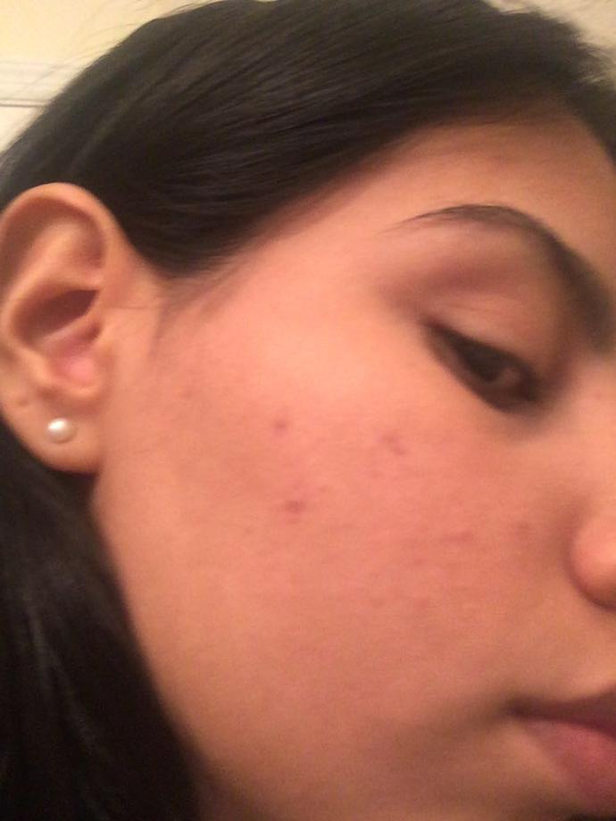 Girls, What could you recommend me that has worked for you to get rid of past acne marks ( dark spots) help!!!?