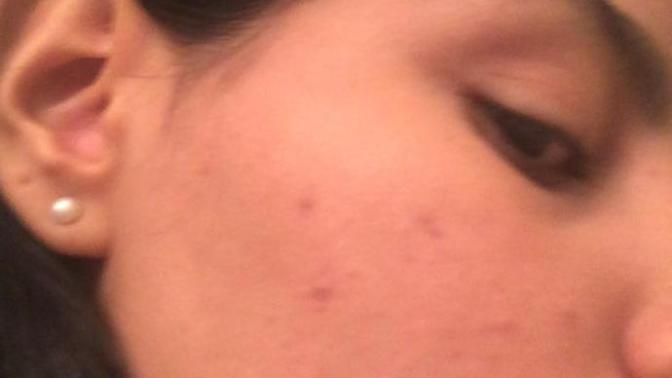 Girls, What could you recommend me that has worked for you to get rid of past acne marks ( dark spots) help?