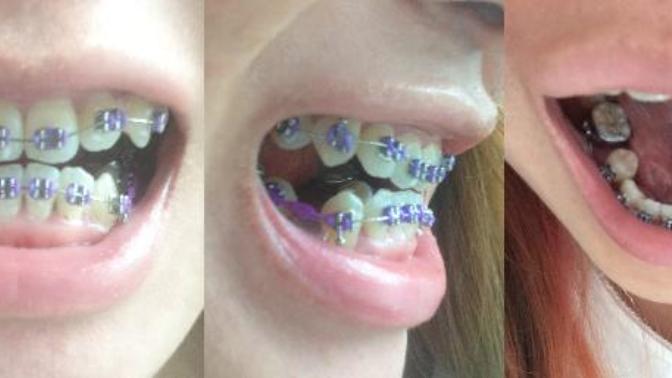 How bad do my new braces look?