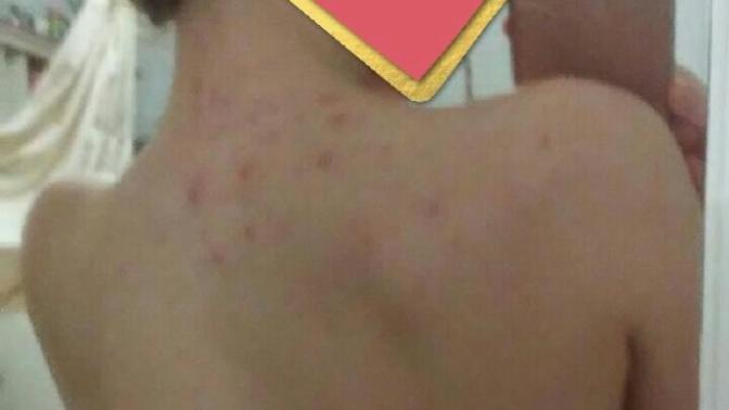 (Picture) Back Acne, does it make you less attractive?