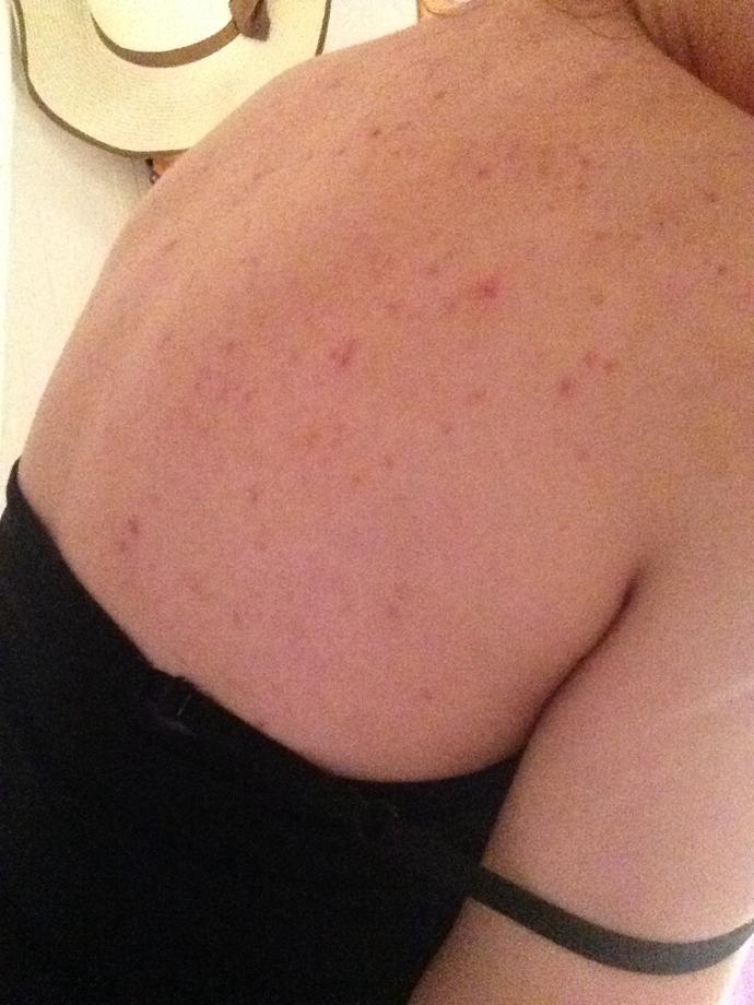 Does anyone have any back acne or chest acne clearing tips?