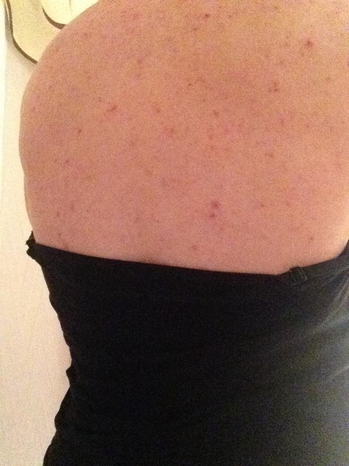 Does anyone have any back acne or chest acne clearing tips?