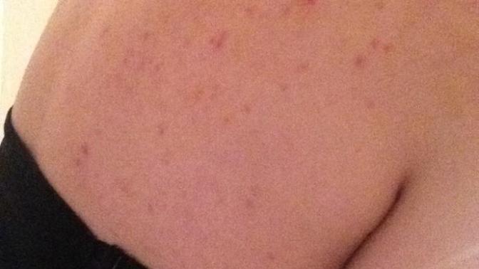 Does anyone have any back acne or chest acne clearing tips?