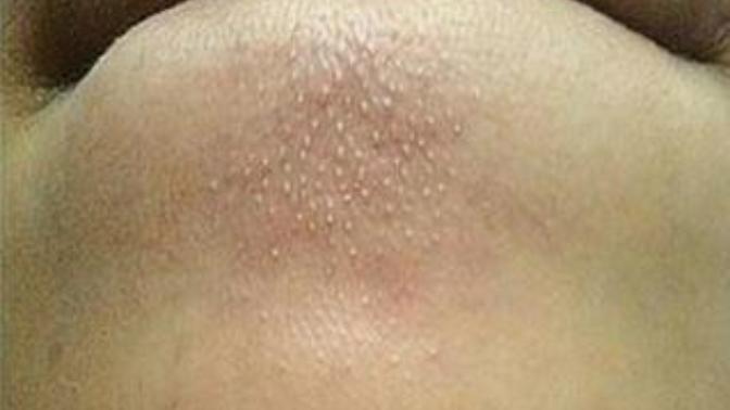 How do you get rid of milia bumps?