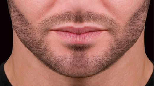 Girls, Would you rather have hair, but also a beard that you can't fully remove or being bald and never allowed to wear a wig?