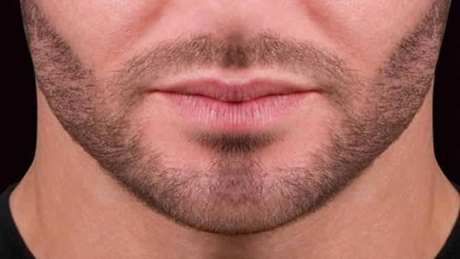 Girls, Would you rather have hair, but also a beard that you can't fully remove or being bald and never allowed to wear a wig?