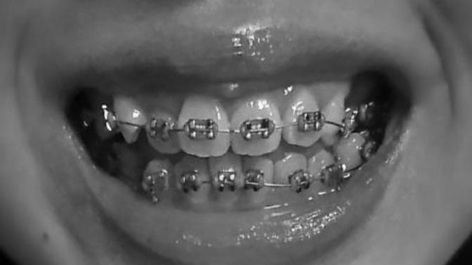 Girls, Would you say my braces look unsightly?