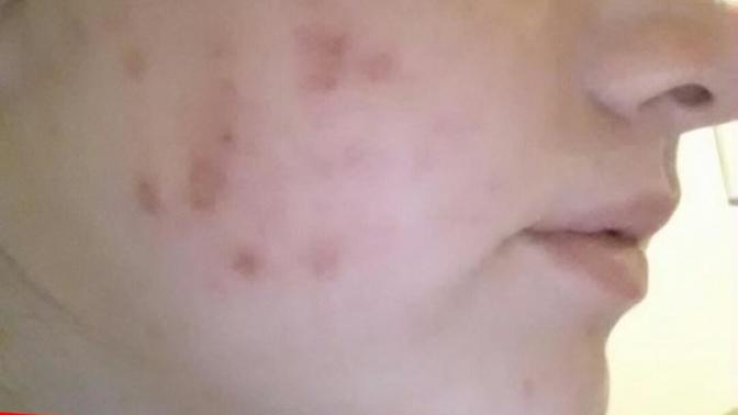 Don't hate on my pictures, but how to treat me cysts/ acne scars?