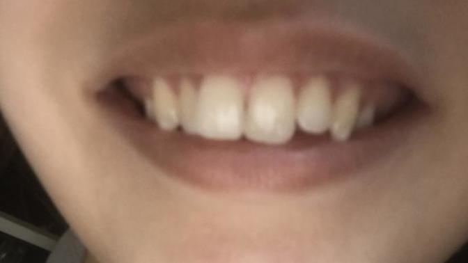 Do my top teeth look like I need braces?