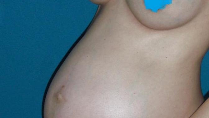 Why are my wife's breasts lopsided? Hurry up before they are removed?