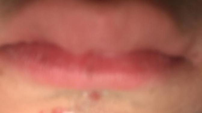 Upper lip have scar thing but not scar advice please any way to fix this?