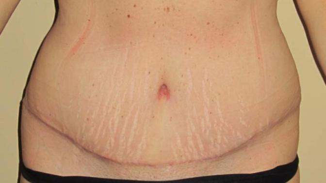 Honestly, would you consider dating/marrying someone who had to have a tummy tuck due to weight loss?