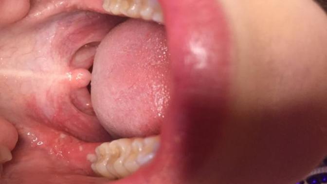 Random cuts all over back of my mouth?
