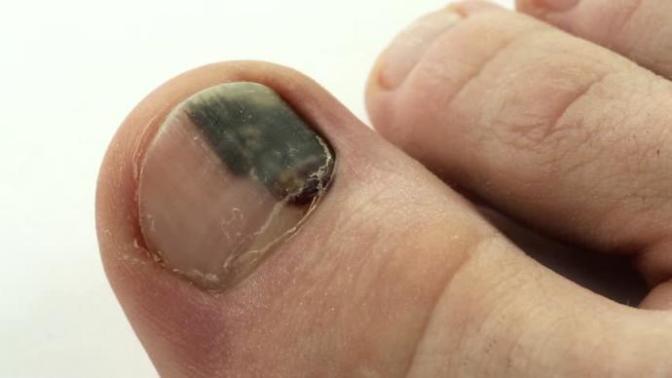 Do Subungual Hematoma go away on their own (link to pic below)?