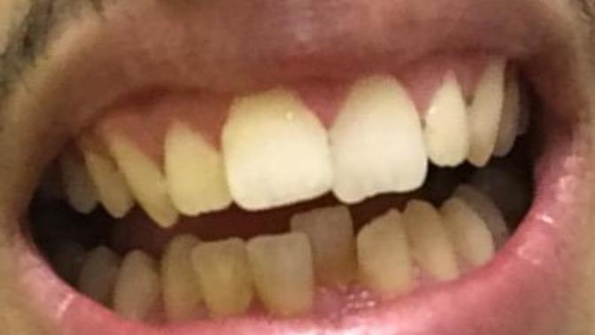 Girls, How off putting are my teeth?