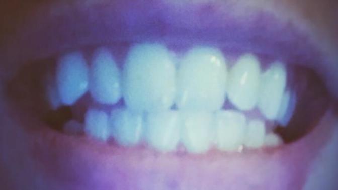 Should I get braces?