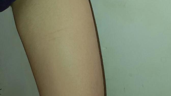 Girls, Hiding self harm?