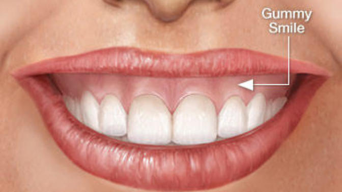 Would you date someone with a gummy smile? what do you think about it?