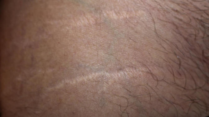 Do you feel insecure about scars or stretch marks on your body?