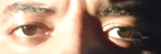Is there discoloration in one of my eyes? Should I see an eye doctor about it?